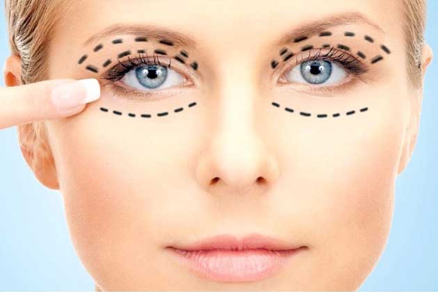 Блефаропластика (пластика верхних/ нижних век)