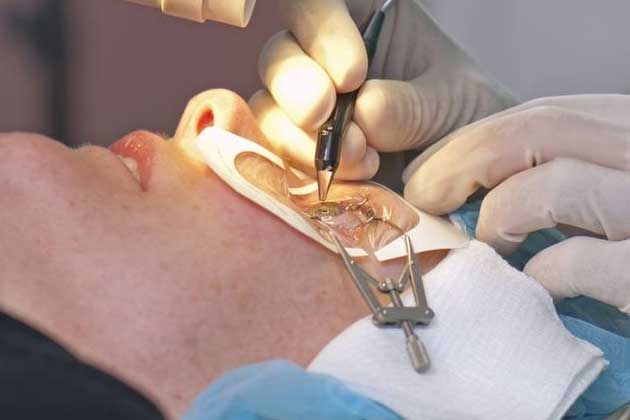 Хирургическое лечение катаракты